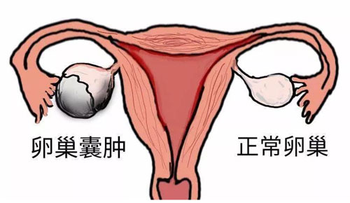 宫颈囊肿可以试管吗？宫颈囊肿可能影响怀孕！